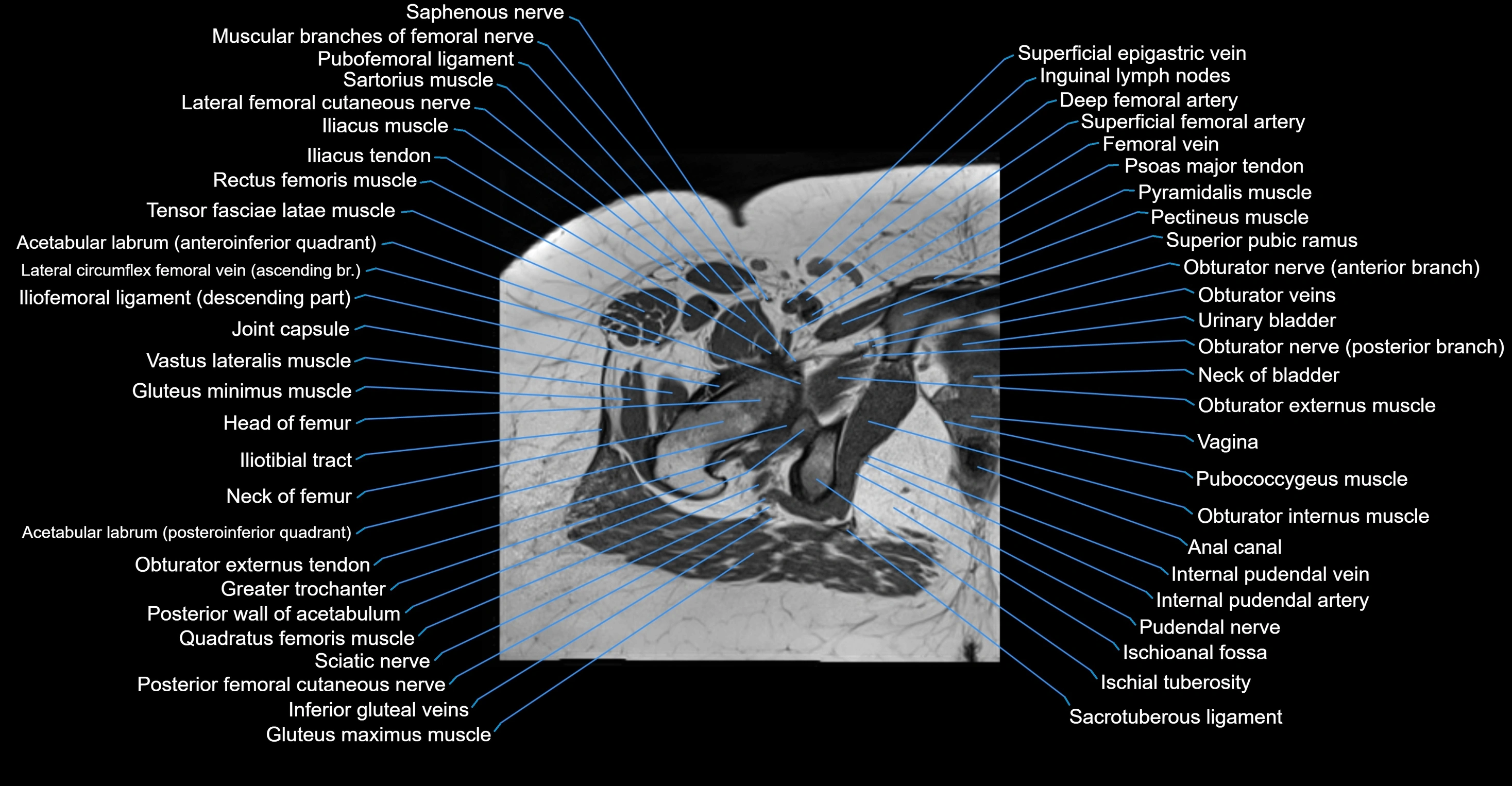 MRI hip axial cross sectional anatomy 3T 3D  radiology  anatomy image-img-00001-00048.webp